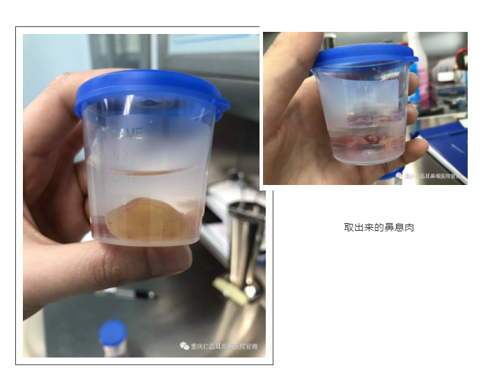 慢性鼻窦炎伴鼻息肉