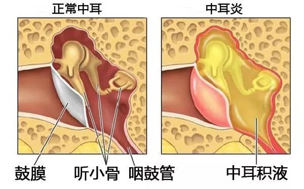 重庆儿童中耳炎的病因有哪些