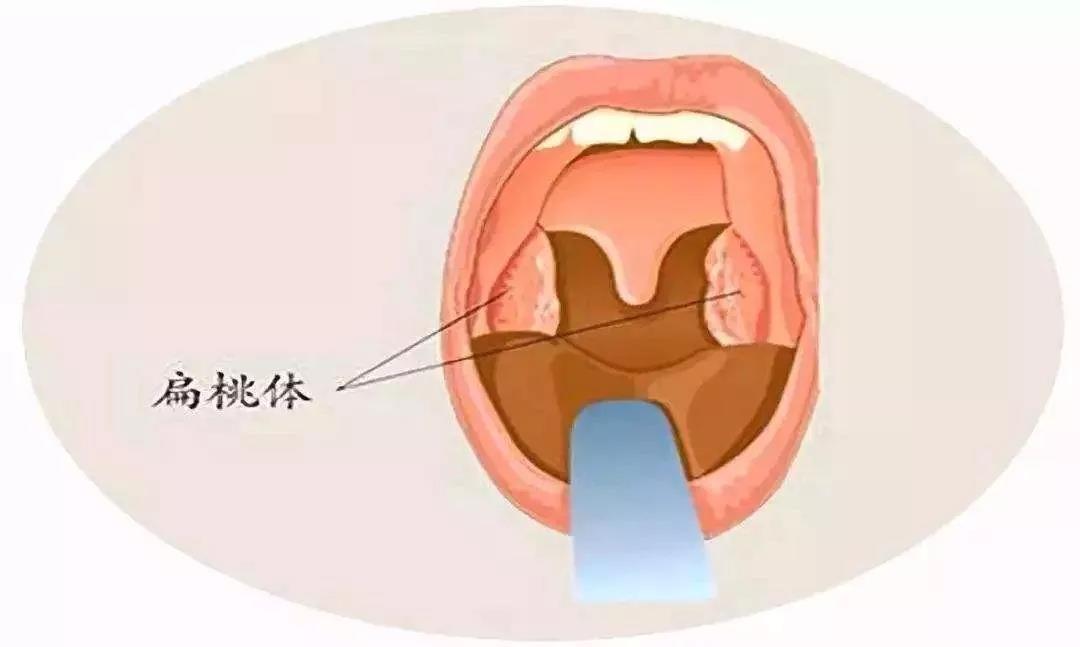 重庆扁桃体炎的病因有哪些