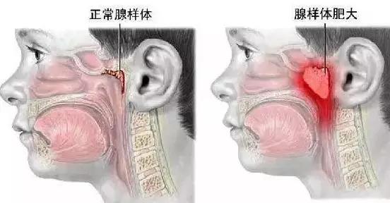 腺样体肥大