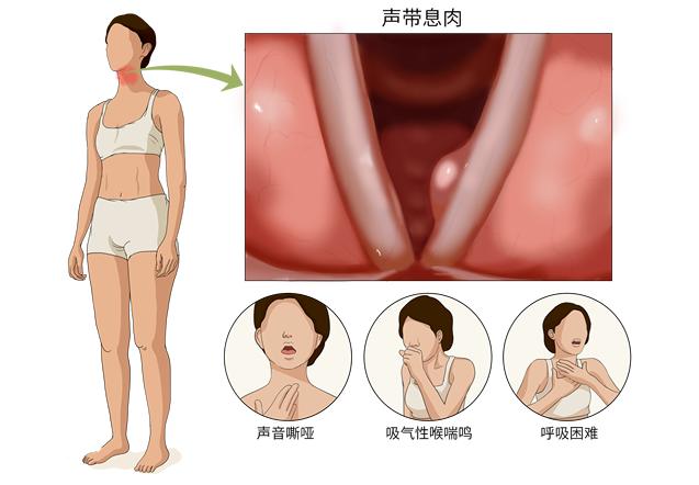 声带息肉