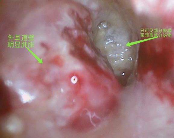 外耳道炎