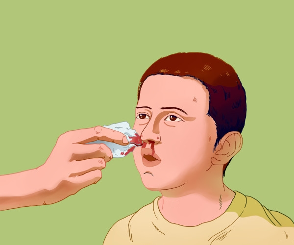 儿童鼻出血