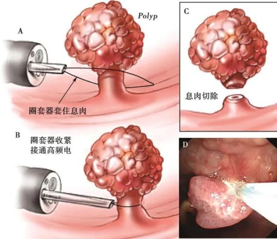 重庆声带息肉手术医院