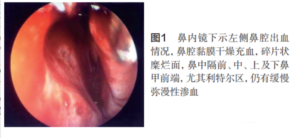 鼻出血