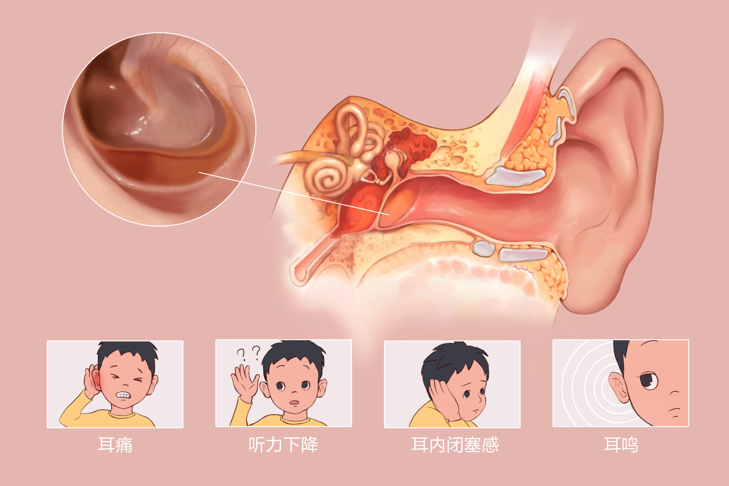 分泌性中耳炎