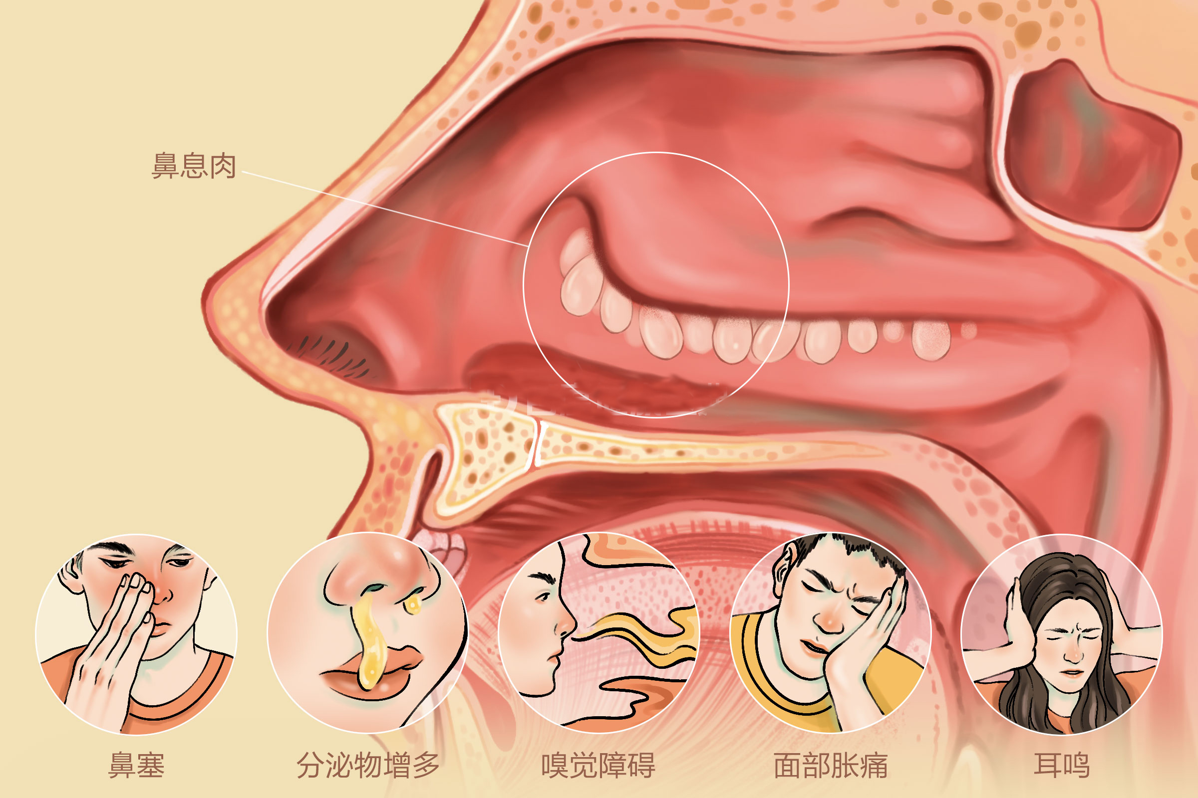 重庆治疗鼻息肉医院