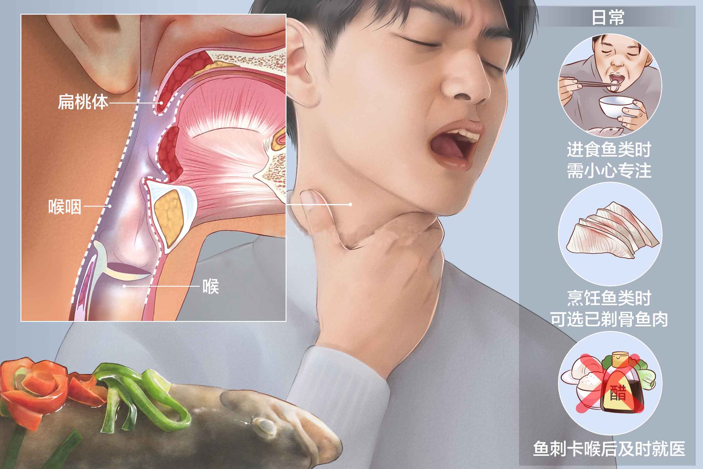 重庆鱼刺卡喉医院怎么处理