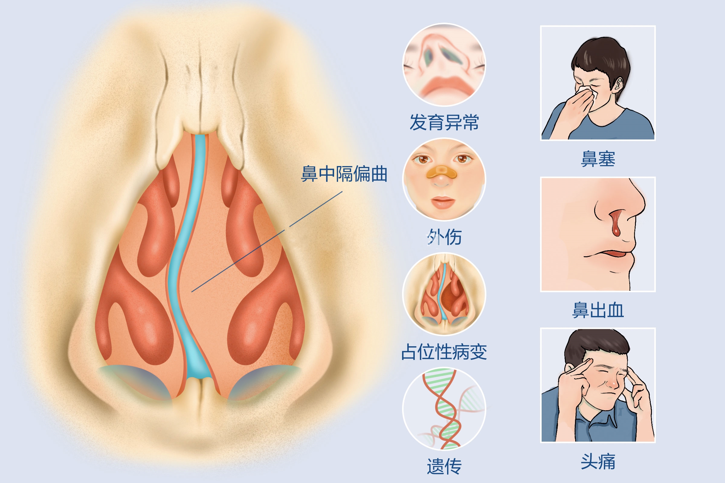 造成鼻中隔偏曲的原因